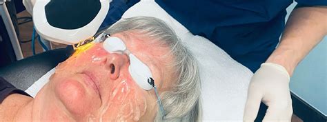 Intense Pulsed Light Therapy At Calgary Dry Eye Treatment Centre