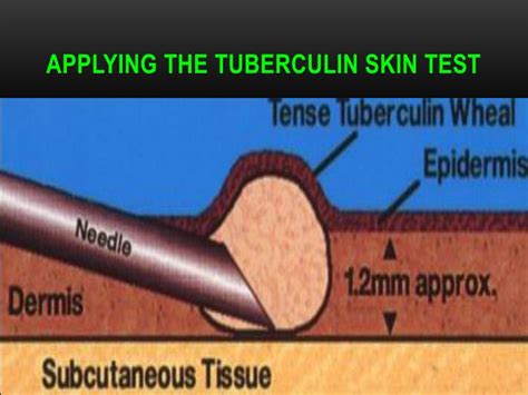 Ppt Tuberculin Skin Testing Mantoux Tuberculin Skin Test
