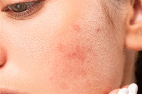 Treatment Plans Acne And Congestion Skin Tone Treatment