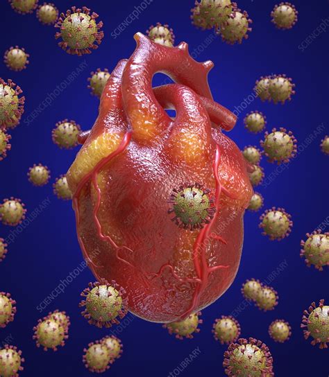 Heart Inflammation In Covid 19 Conceptual Illustration Stock Image