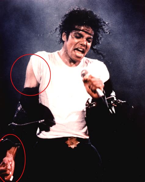 Michael Did Not Change His Skin Color He Had Vitiligo