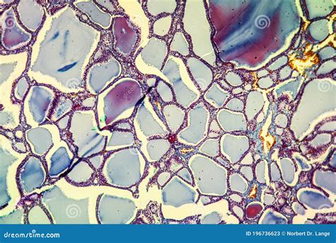 Goiter With Colloid Thyroid Disease Stock Image Image Of Colloid