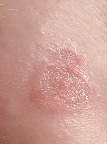 Doctor Says Its A Yeast Infection In My Armpit Underarm Area Thoughts Have Had Symptoms For 8