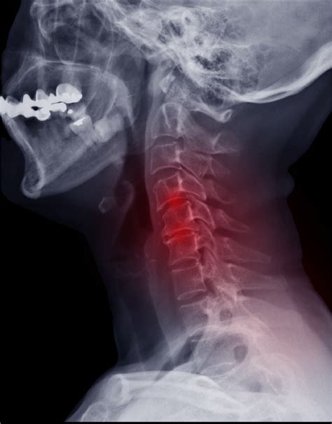 Spine Conditions Cervical Whats New In Cervical Herniated Disc
