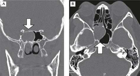 Figure 2 From Isolated Inverted Papilloma Of The Sphenoid Sinus