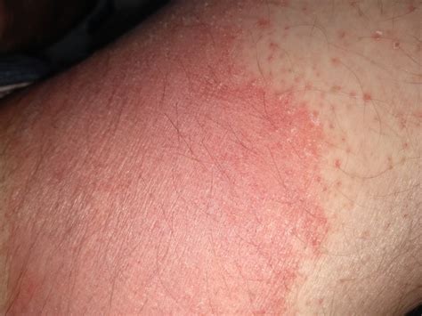 I Have An Embarrassing Rash On My Inner Thigh Any Advice As I Dont