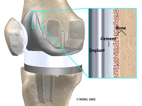 Minimally Invasive Knee Replacement Surgery Engineering Replacement