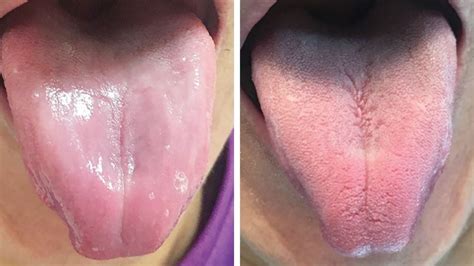Bizarre Photo Shows Mans Smooth Tongue After His Taste Buds Disappear