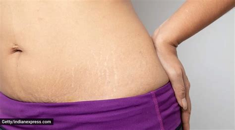 Say Goodbye To Stretch Marks With These Natural Remedies Life Style News The Indian Express