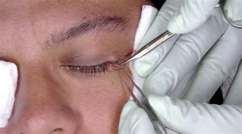 Dr Pimple Popper Treated A Woman With Bumps Around Her Eyes Business