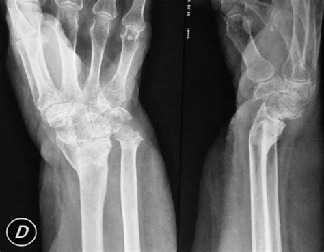 L Shaped Corrective Osteotomy For Distal Radius Malunion