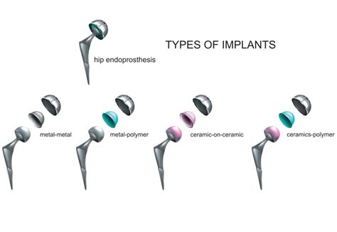 Hip Replacement Surgery What Are Your Implant Options Add More To