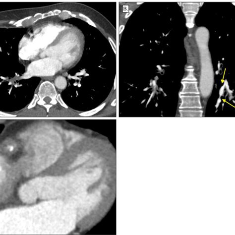 Contrast Enhanced Chest Computed Tomography Images For Patient 2