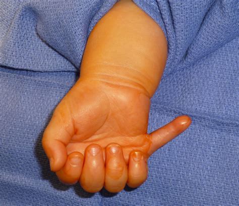 Extra Digits Congenital Hand And Arm Differences