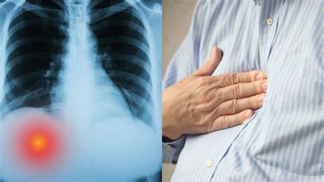 Hiatus hernia or hiatal hernia can cause this.paraesophageal type hiatus hernia is the cause of a bulge in the right side below ribcage on my body. Large Intestine Pain Right Side | Bruin Blog