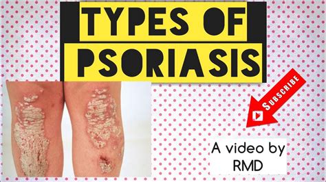 Psoriasis Types Image Based Discussion Youtube