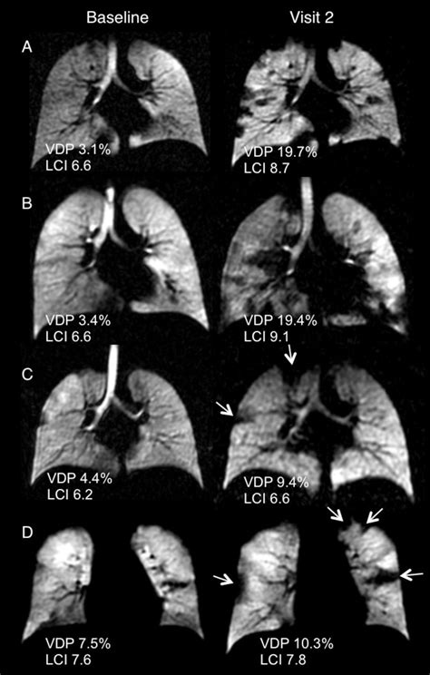 Time To Get Serious About The Detection And Monitoring Of Early Lung