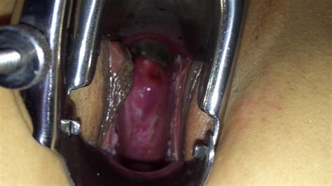 Deep View Inside Woman With Speculum Nice View Of Cervix Xhamster