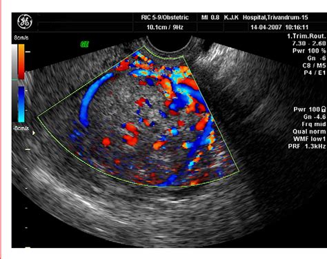 Figure 3 From Endometrial Stromal Sarcoma Mimicking A Myoma Semantic