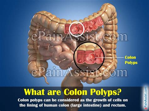 What Are Colon Polyps And What Are Its Causes Types Symptoms