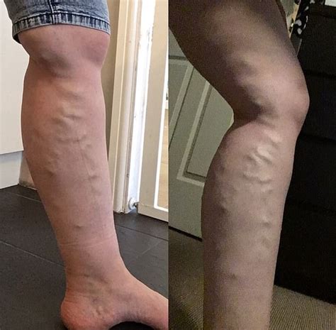 Mother With Varicose Veins So Painful She Struggled To Walk Was Refused