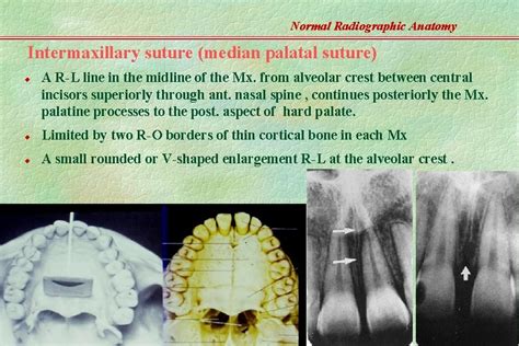 Normal Radiographic Anatomy Based On Intraoral Films Teeth