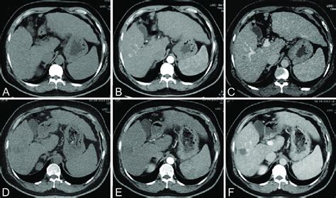 A F Axial Triple Phase Ct Scan Images Unenhanced A Arterial B