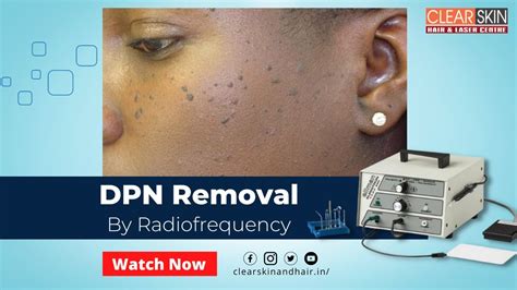 Dpn Removal Treatment By Radiofrequency Device Laser Treatment For