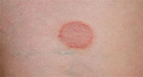 Ringworm Treatment For Humans Apps Directories