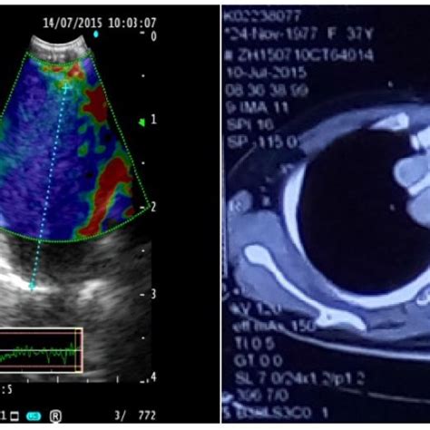 Convex Endobronchial Ultrasound Ebus A Ebus Scope With Associated