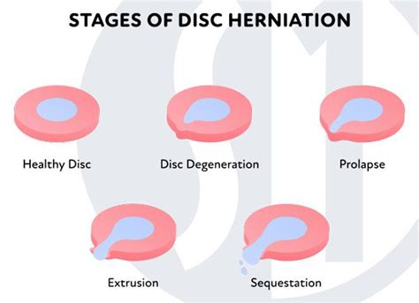 Herniated Bulging Slipped Disc Degeneration Types Explained