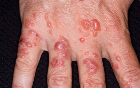How To Handle Poison Ivy Blisters