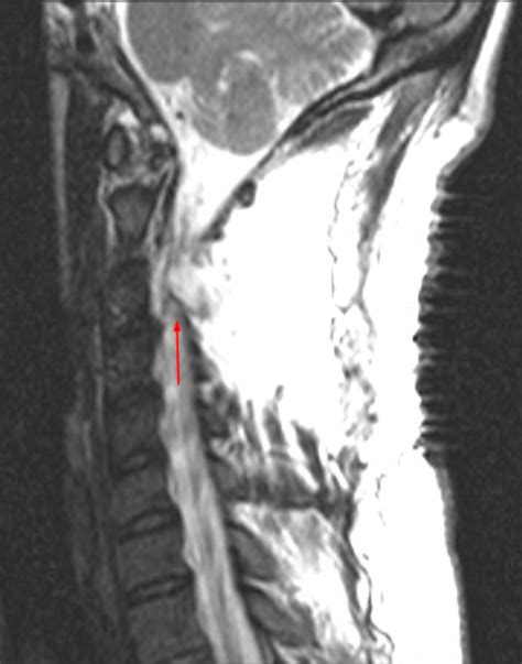 Cervical Spine Sagittal Mri Without Contrast Demonstrating A Large