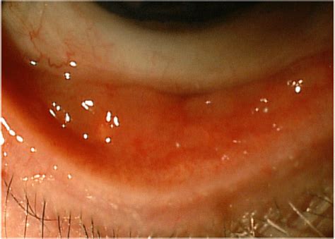 Photograph Demonstrating Inferior Palpebral Conjunctival Injection And