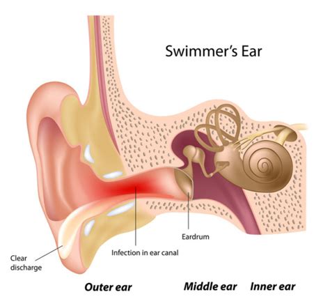 Blocked Ear Treatment And Prevention Of Swimmers Ear University