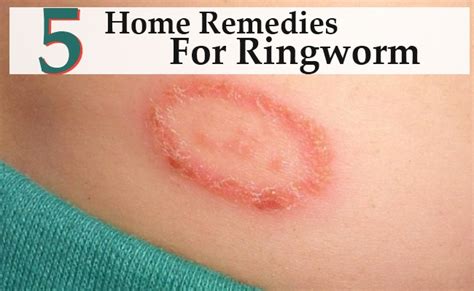 Home Remedies For Ringworm Morpheme Remedies India