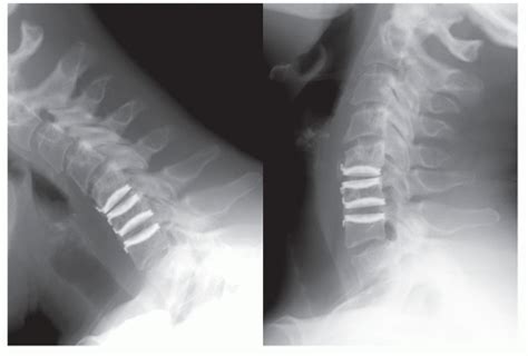 Artificial Disk Surgery Of The Cervical Spine Multilevel Disk