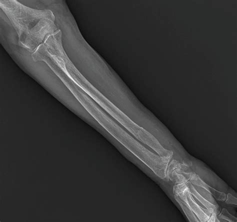 Fractured Ulna Arm Bone Photograph By Zephyr Science Photo Library Pixels