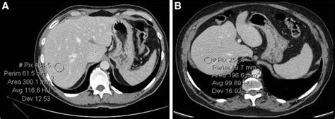 Ct Images Of Upper Abdomen A Axial Ct Image Of Upper Abdomen Obtained