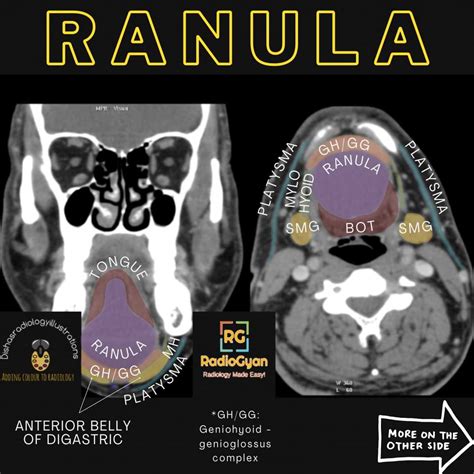 Ranula Radiology Case Radiogyan