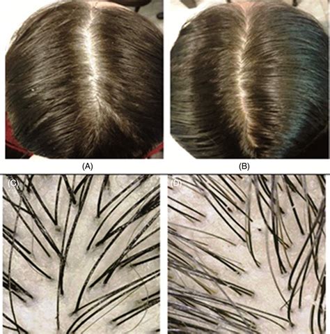 A Female Patient With Telogen Effluvium Shows Decreased Hair Density