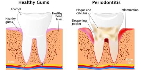 Stages Of Periodontal Disease Bisson Dentistry