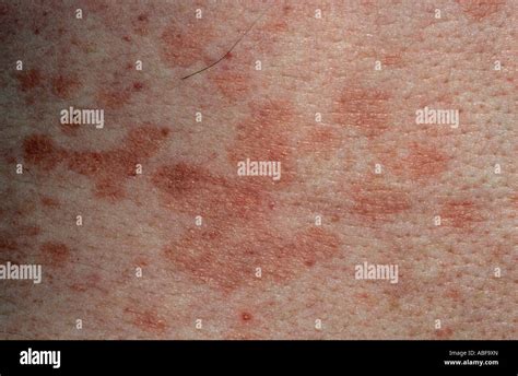 Pityriasis Rosea Rash Hi Res Stock Photography And Images Alamy