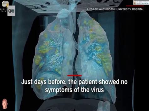 Japanese Doctors Perform Worlds First Living Donor Lung Transplant To