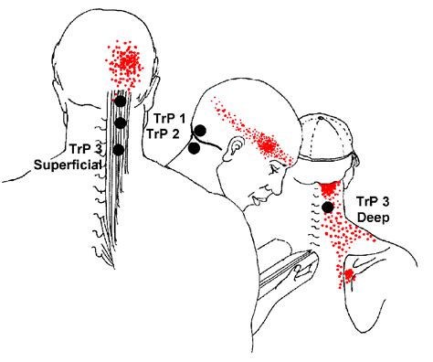 Burning Pain At Base Of Brain Semispinalis Capitis Head Pain And