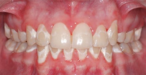 Why Do I Have White Spots On My Teeth Peninsula Orthodontics