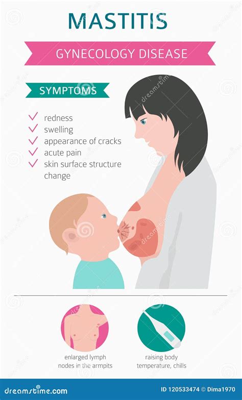 Mastitis Breastfeed Medical Infographic Diagnostics Symptoms Stock Vector Illustration Of