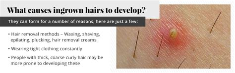Best Hair Removal For Ingrown Hair Prone Skin How To Get Rid Of