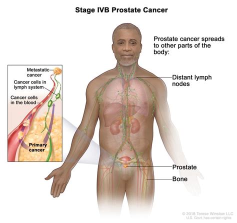 Prostate Cancer Treatment Pdq®health Professional Version Nci