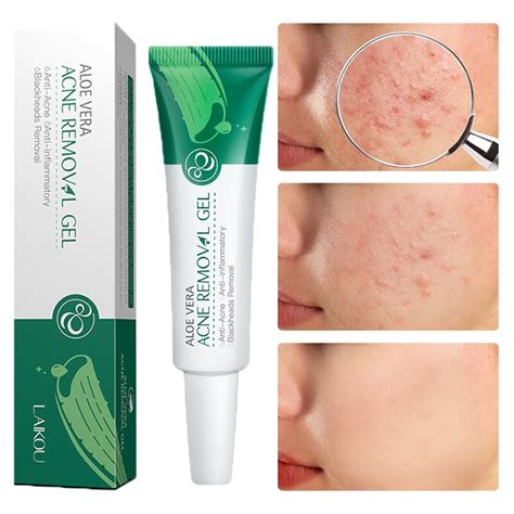 Effective Acne Removal Cream Acnes Scar Repair Gel Treatment Pimples Moisturizing Smooth Shrink
